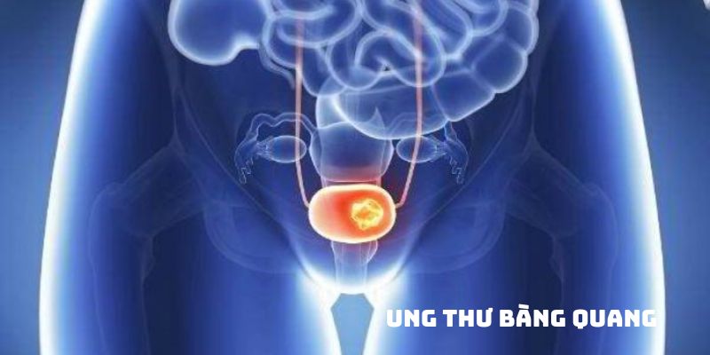 Ung thư bàng quang phổ biến liên quan đến hệ tiết niệu