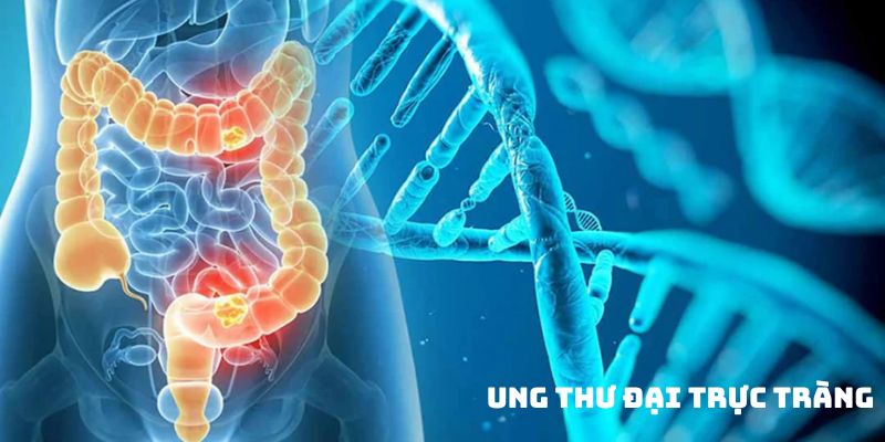 Ung thư đại trực tràng loại ung thư phổ biến nhất toàn cầu