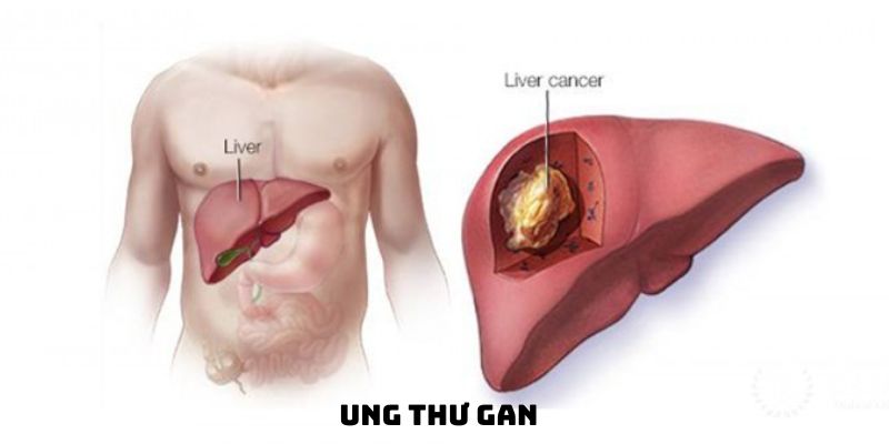 Ung thư gan: hiểu biết toàn diện, phòng ngừa và điều trị