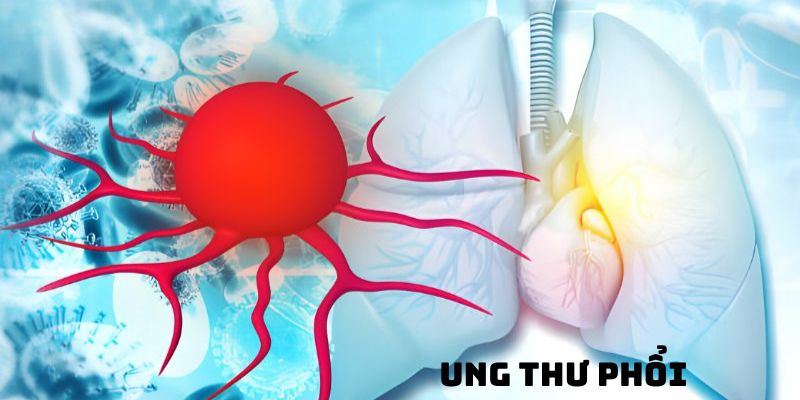 Nguyên nhân khiến ung thư phổi ngày càng gia tăng