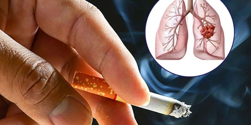 Phương pháp nào giúp phát hiện ung thư phổi?