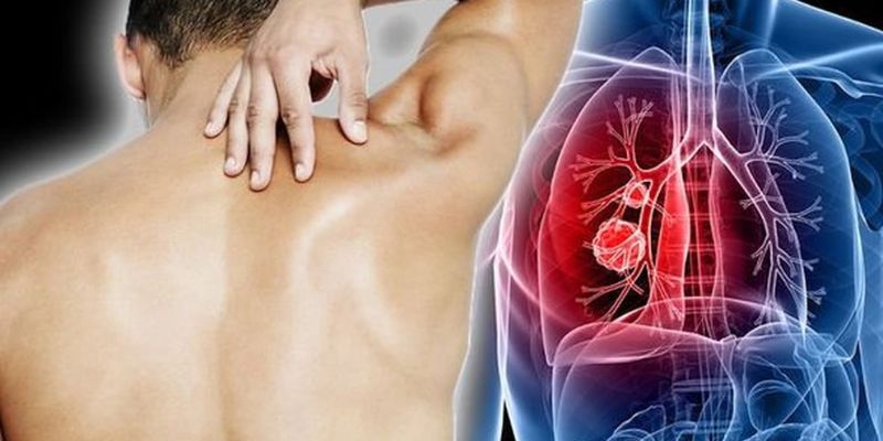 Lựa chọn điều trị nào cho ung thư phổi?