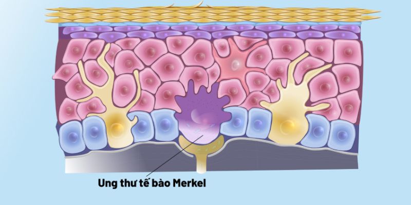 Ung thư tế bào Merkel là gì? Tổng quan về MCC