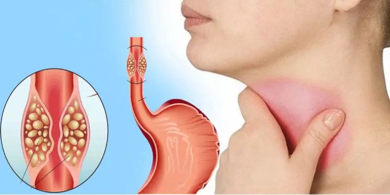 Ung thư thực quản: Nguyên nhân, triệu chứng và cách điều trị