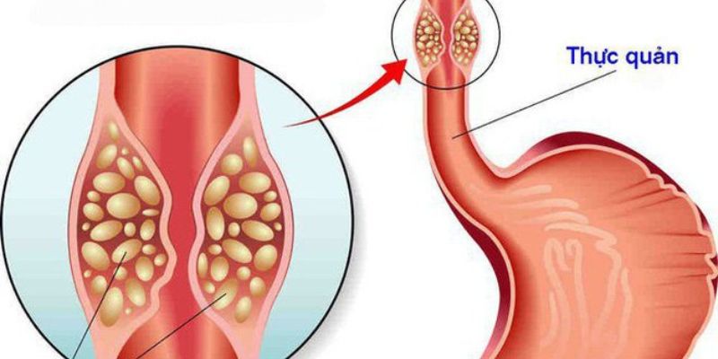 Những ai có nguy cơ cao mắc ung thư thực quản?