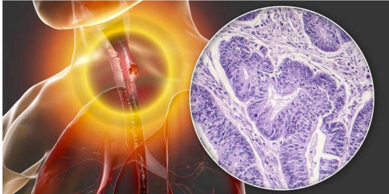 Triệu chứng của ung thư thực quản là gì?