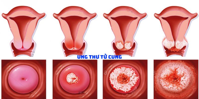 Ung thư tử cung