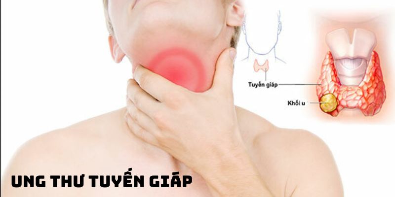Ung thư tuyến giáp phòng ngừa và điều trị toàn diện