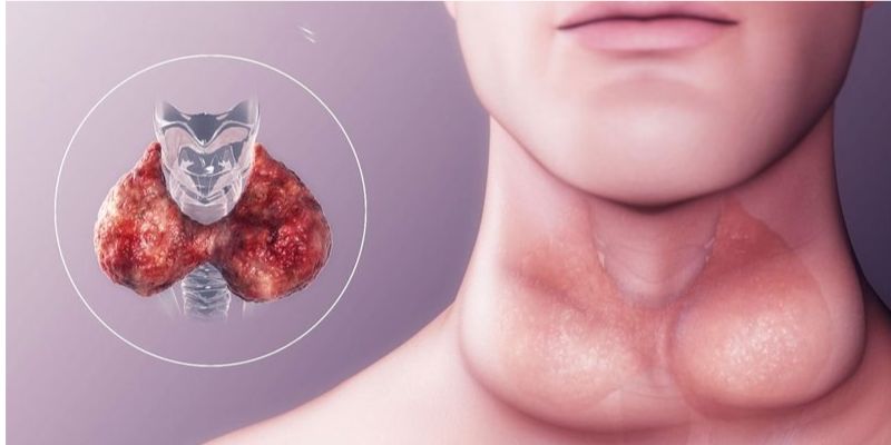 Triệu chứng của ung thư tuyến giáp là gì?