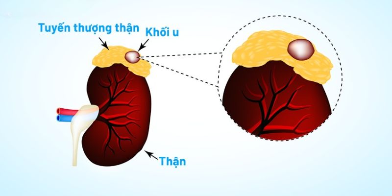 Ung thư tuyến thượng thận là gì?