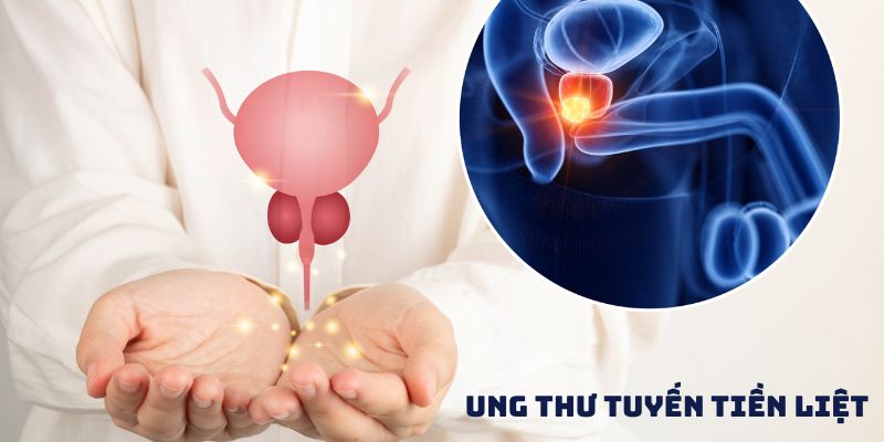 Ung thư tuyến tiền liệt phòng ngừa và điều trị toàn diện