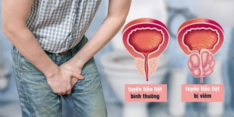 Ung thư tuyến tiền liệt là gì?