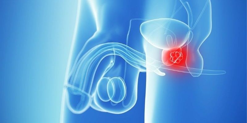 Nguyên nhân gây ung thư tuyến tiền liệt là gì?