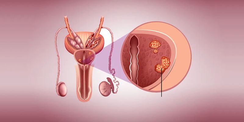 Làm thế nào để chẩn đoán ung thư tuyến tiền liệt?