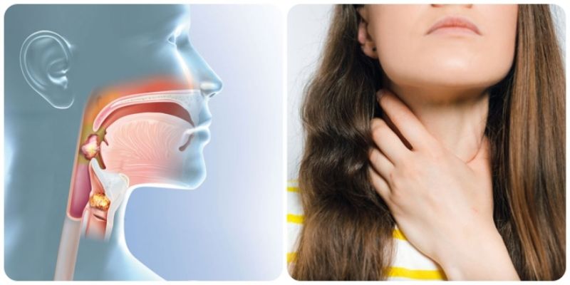 Ung Thư Vòm Họng: Hiểu Biết, Phòng Ngừa và Điều Trị Toàn Diện