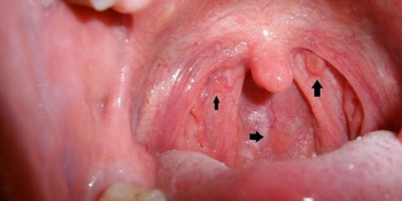 Ung thư vòm họng là gì?