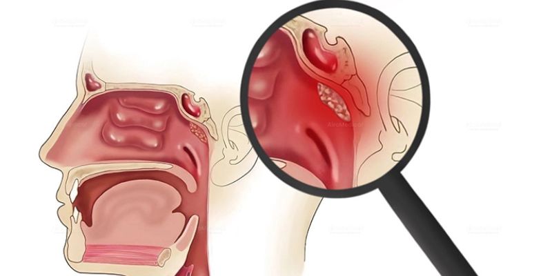 Ung thư vòm họng có lây không?