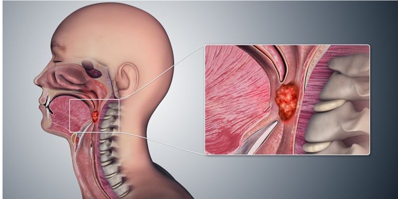 Ung thư vòm họng tiến triển ra sao?