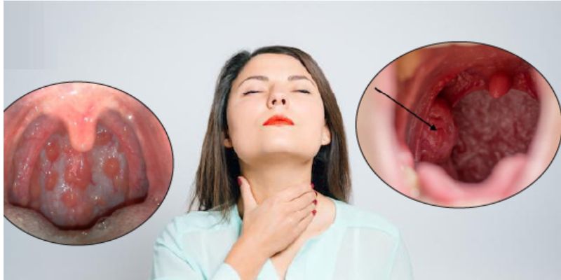 Làm gì để giảm nguy cơ ung thư vòm họng?