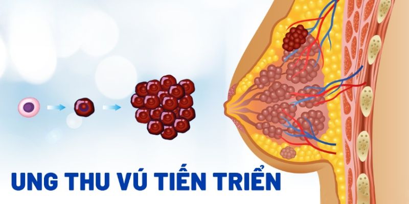 Triệu chứng của ung thư vú là gì?